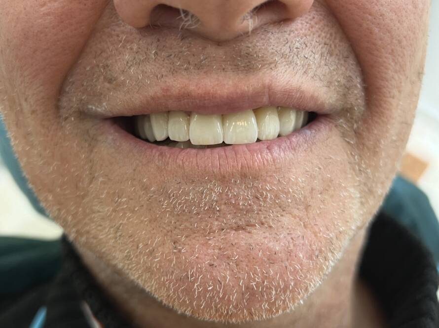 Circolare su denti naturali