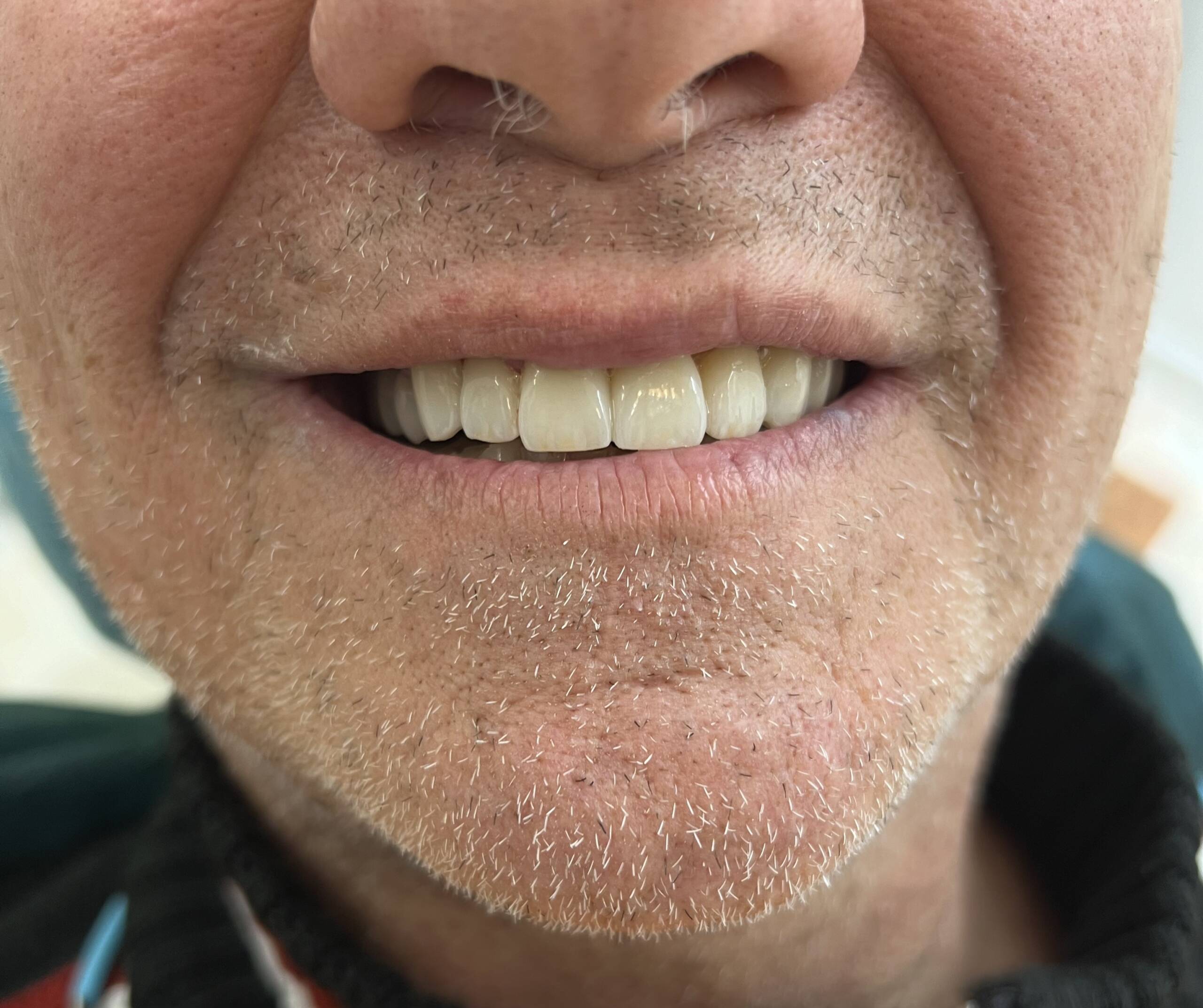 Circolare su denti naturali